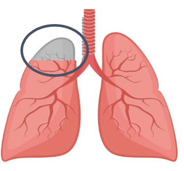 Segmentectomy illustration