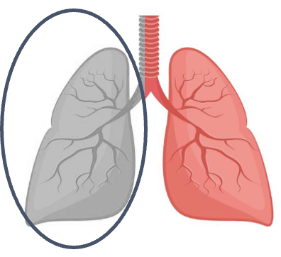 Pneumonectomy illustration