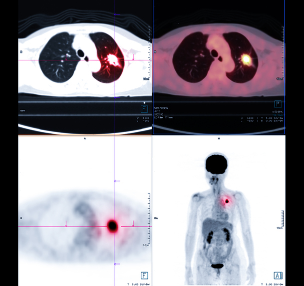 PET scan example