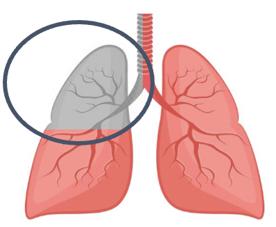 Lobectomy illustration